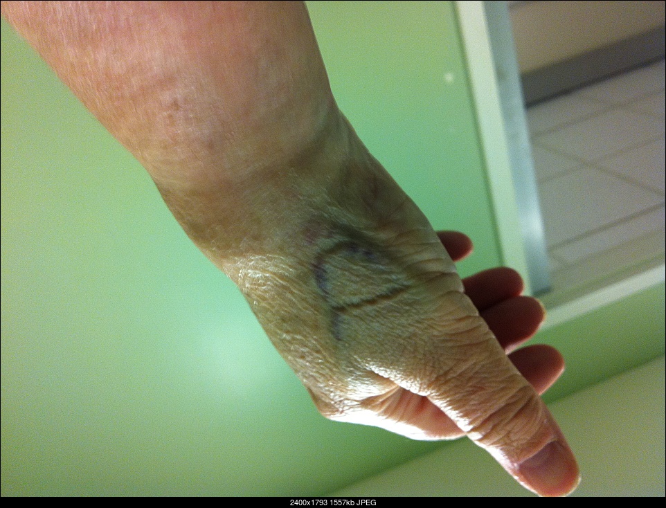 Click image for larger version. 

Name:	R wrist before surgery.jpg 
Views:	56 
Size:	1.52 MB 
ID:	373342