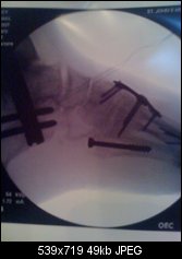 Click image for larger version. 

Name:	lisfranc #2.jpg 
Views:	157 
Size:	49.5 KB 
ID:	95598